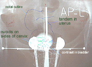 CET's Demaes-Rodriguez Tandem and Ovoics Applicator