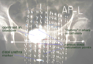 Interstitil Implants: Dummy Radiation source is apprear as dotted line.