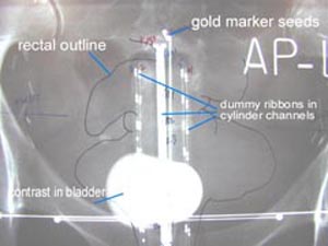 CET's Multichannel Vaginal Cylender Aplicator Setup